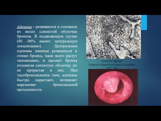 Аденома - развивается в основном из желез слизистой оболочки бронхов. В