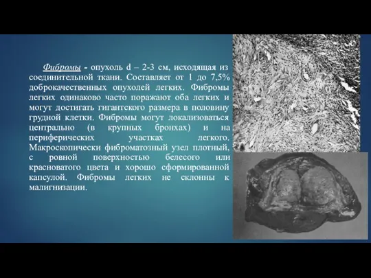 Фибромы - опухоль d – 2-3 см, исходящая из соединительной ткани.