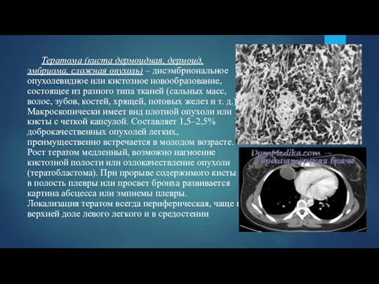 Тератома (киста дермоидная, дермоид, эмбриома, сложная опухоль) – дисэмбриональное опухолевидное или