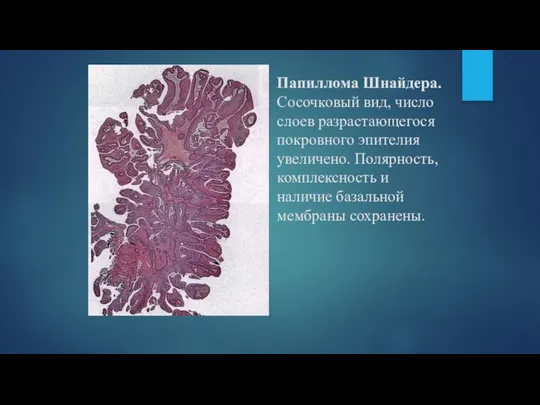 Папиллома Шнайдера. Сосочковый вид, число слоев разрастающегося покровного эпителия увеличено. Полярность,