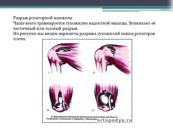 Разрыв ротаторной манжеты Чаще всего травмируется сухожилие надостной мышцы. Возникает её