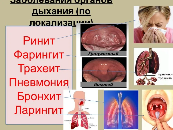 Заболевания органов дыхания (по локализации) Ринит Фарингит Трахеит Пневмония Бронхит Ларингит