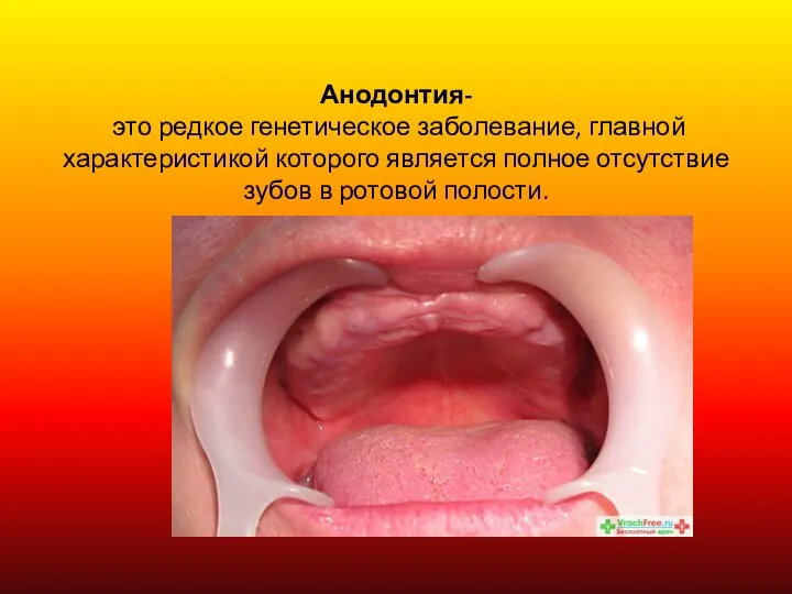 Анодонтия- это редкое генетическое заболевание, главной характеристикой которого является полное отсутствие зубов в ротовой полости.