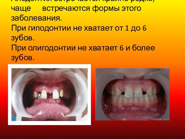 Анодонтия встречается крайне редко, чаще встречаются формы этого заболевания. При гиподонтии