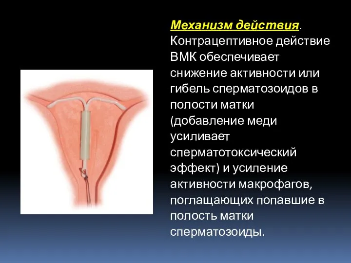 Механизм действия. Контрацептивное действие ВМК обеспечивает снижение активности или гибель сперматозоидов