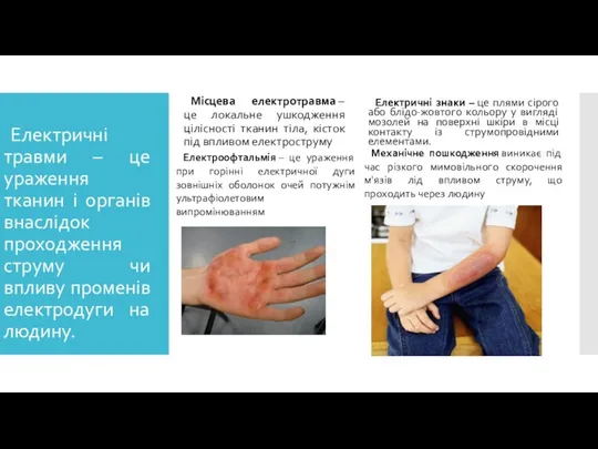 Електричні травми – це ураження тканин і органів внаслідок проходження струму