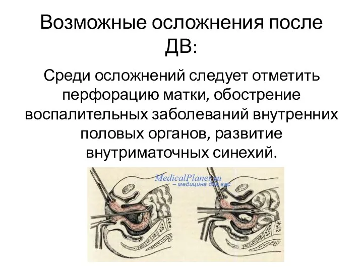 Возможные осложнения после ДВ: Среди осложнений следует отметить перфорацию матки, обострение