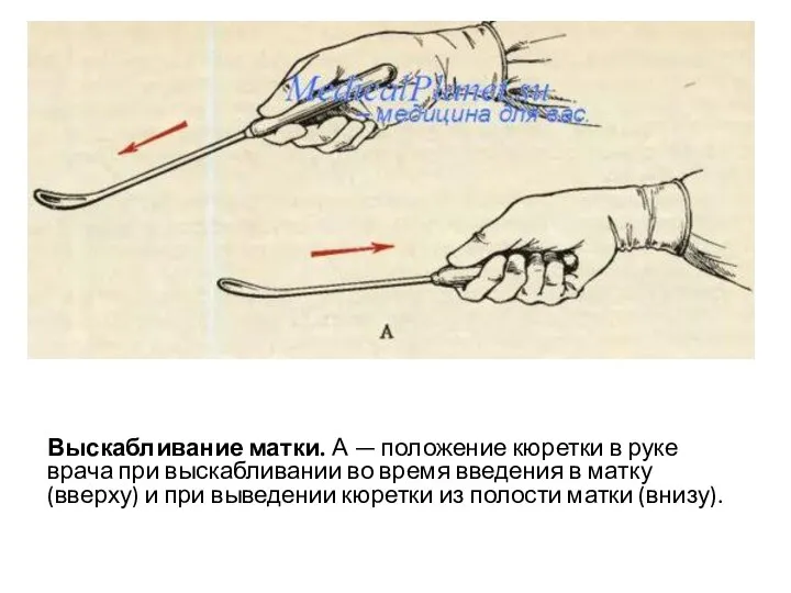 Выскабливание матки. А — положение кюретки в руке врача при выскабливании