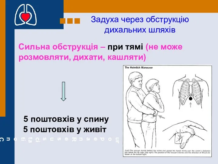 Задуха через обструкцію дихальних шляхів Сильна обструкція – при тямі (не