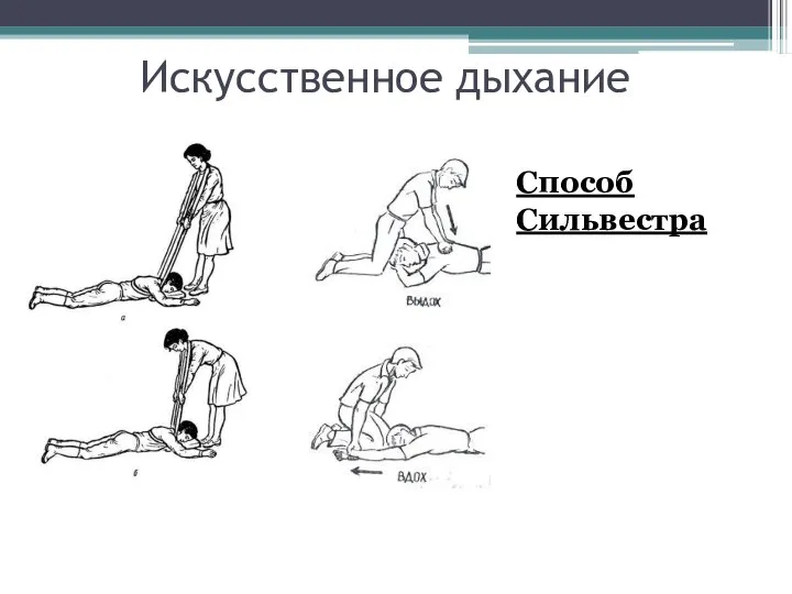 Искусственное дыхание Способ Сильвестра