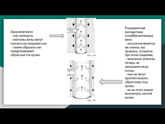 Здоровая вена - она натянута; - клапаны вены могут полностью закрываться;