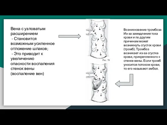 Вена с узловатым расширением - Становится возможным усиленное отложение шлаков; -