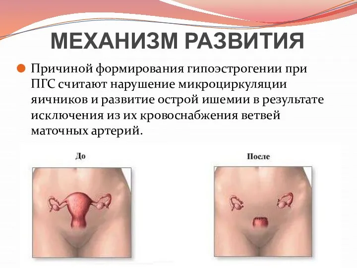 МЕХАНИЗМ РАЗВИТИЯ Причиной формирования гипоэстрогении при ПГС считают нарушение микроциркуляции яичников