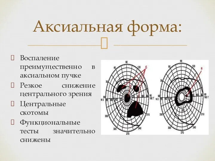 Аксиальная форма: Воспаление преимущественно в аксиальном пучке Резкое снижение центрального зрения