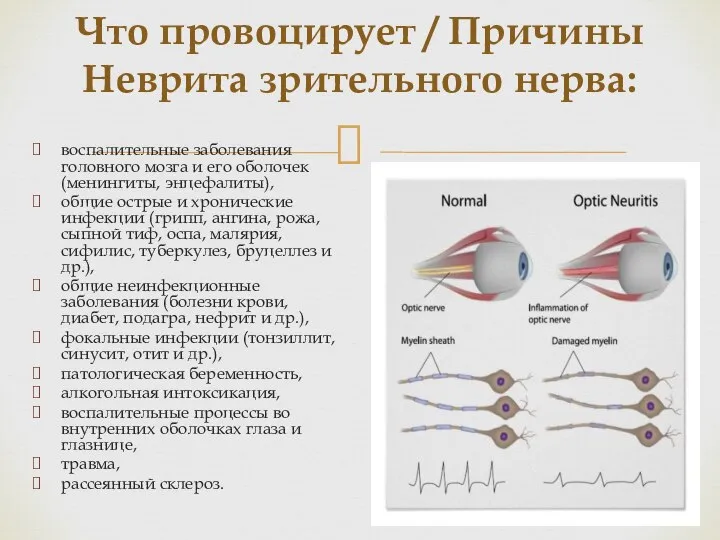 Что провоцирует / Причины Неврита зрительного нерва: воспалительные заболевания головного мозга