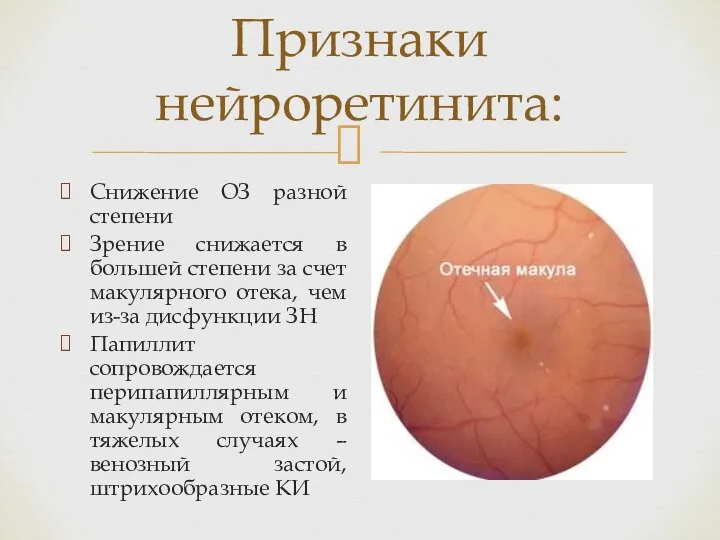 Признаки нейроретинита: Снижение ОЗ разной степени Зрение снижается в большей степени