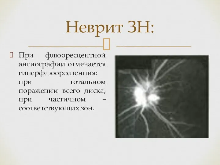 Неврит ЗН: При флюоресцентной ангиографии отмечается гиперфлюоресценция: при тотальном поражении всего