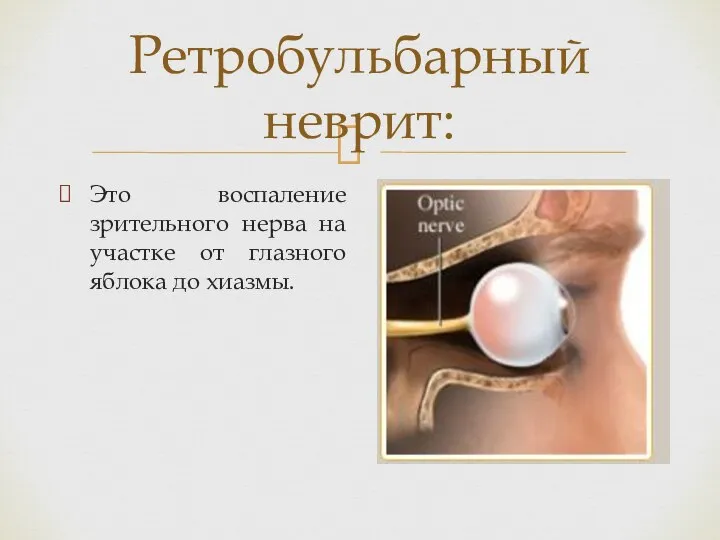 Ретробульбарный неврит: Это воспаление зрительного нерва на участке от глазного яблока до хиазмы.