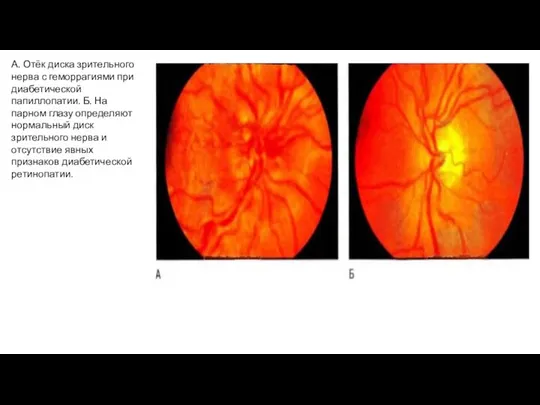 А. Отёк диска зрительного нерва с геморрагиями при диабетической папиллопатии. Б.