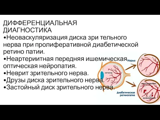 ДИФФЕРЕНЦИАЛЬНАЯ ДИАГНОСТИКА •Неоваскуляризация диска зри­ тельного нерва при пролифера­тивной диабетической ретино­