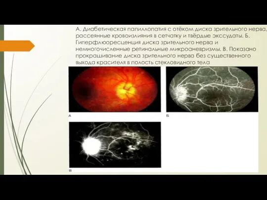 А. Диабетическая папиллопатия с отёком диска зрительного нерва, рассеянные кровоизлияния в