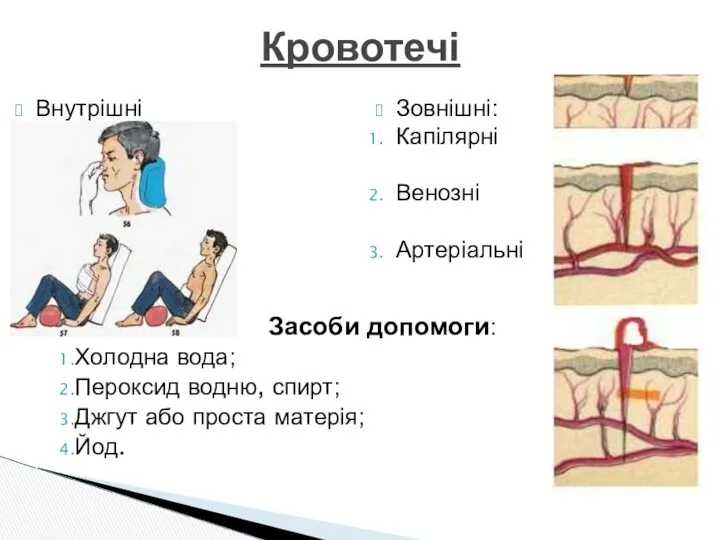 Кровотечі Внутрішні Зовнішні: Капілярні Венозні Артеріальні Засоби допомоги: Холодна вода; Пероксид