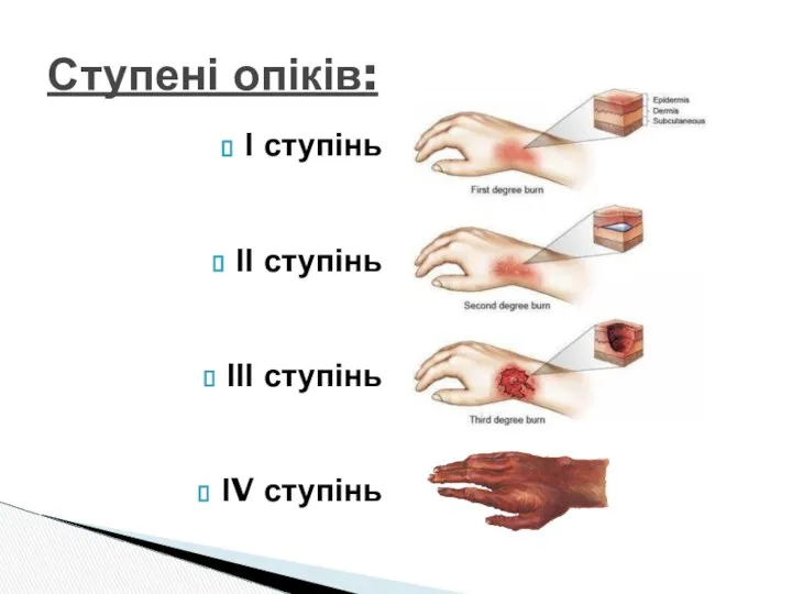 Ступені опіків: І ступінь ІІ ступінь ІІІ ступінь ІV ступінь