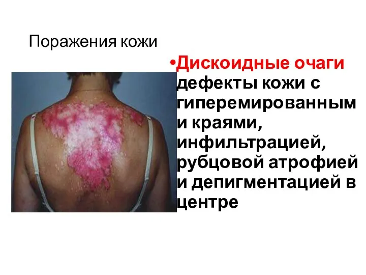 Поражения кожи Дискоидные очаги дефекты кожи с гиперемированными краями, инфильтрацией, рубцовой атрофией и депигментацией в центре