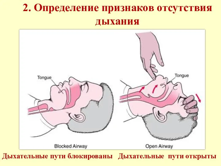 2. Определение признаков отсутствия дыхания Дыхательные пути блокированы Дыхательные пути открыты