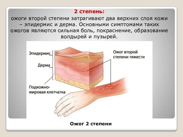 2 степень: ожоги второй степени затрагивают два верхних слоя кожи –