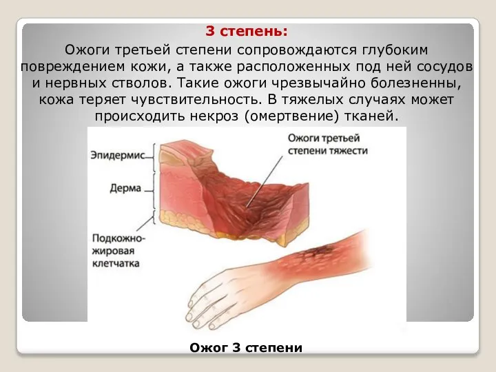 3 степень: Ожоги третьей степени сопровождаются глубоким повреждением кожи, а также