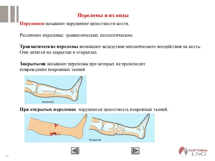 Переломом называют нарушение целостности кости. Различают переломы: травматические; патологические. Травматические переломы