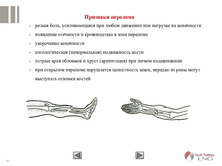 Признаки перелома резкая боль, усиливающаяся при любом движении или нагрузке на