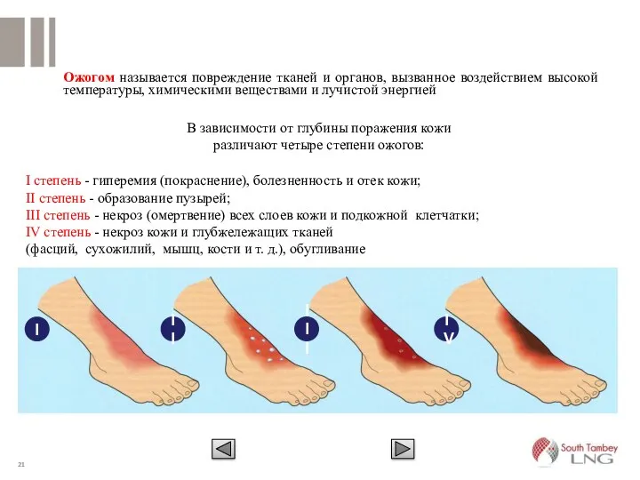 Ожогом называется повреждение тканей и органов, вызванное воздействием высокой температуры, химическими