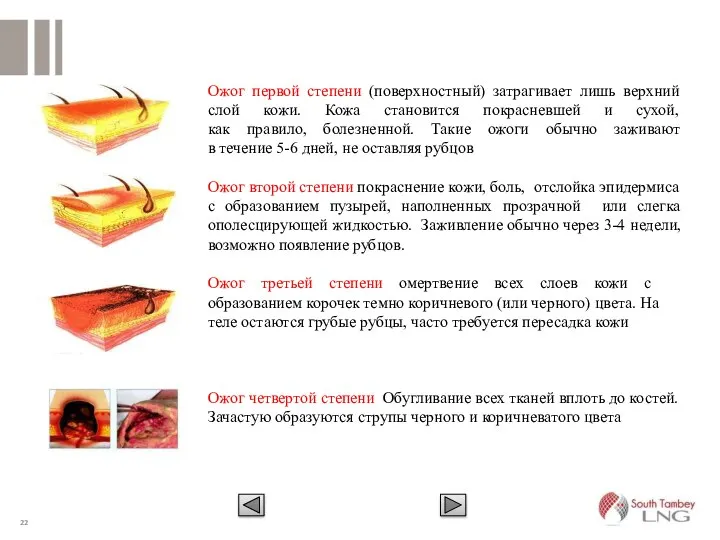 Ожог первой степени (поверхностный) затрагивает лишь верхний слой кожи. Кожа становится