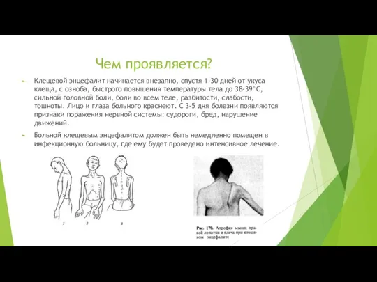 Чем проявляется? Клещевой энцефалит начинается внезапно, спустя 1-30 дней от укуса