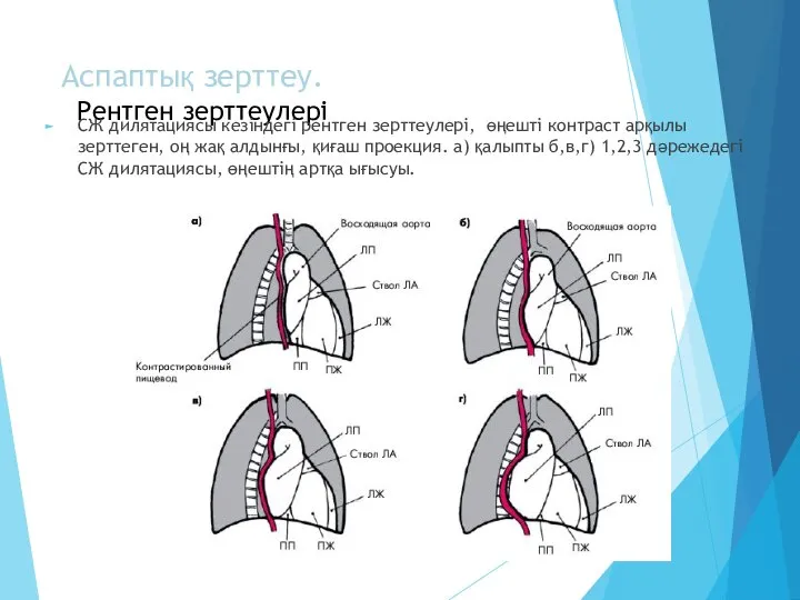 Аспаптық зерттеу. Рентген зерттеулері СЖ дилятациясы кезіндегі рентген зерттеулері, өңешті контраст