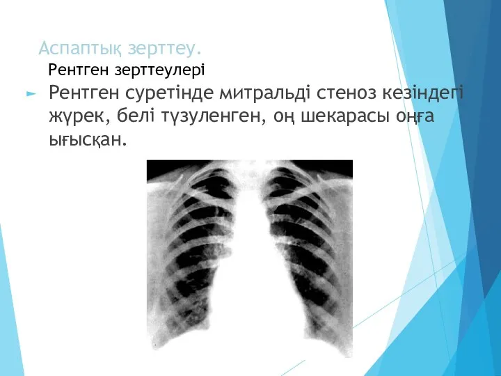 Аспаптық зерттеу. Рентген зерттеулері Рентген суретінде митральді стеноз кезіндегі жүрек, белі түзуленген, оң шекарасы оңға ығысқан.