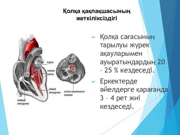 Қолқа сағасының тарылуы жүрек ақауларымен ауыратындардың 20 – 25 % кездеседі.