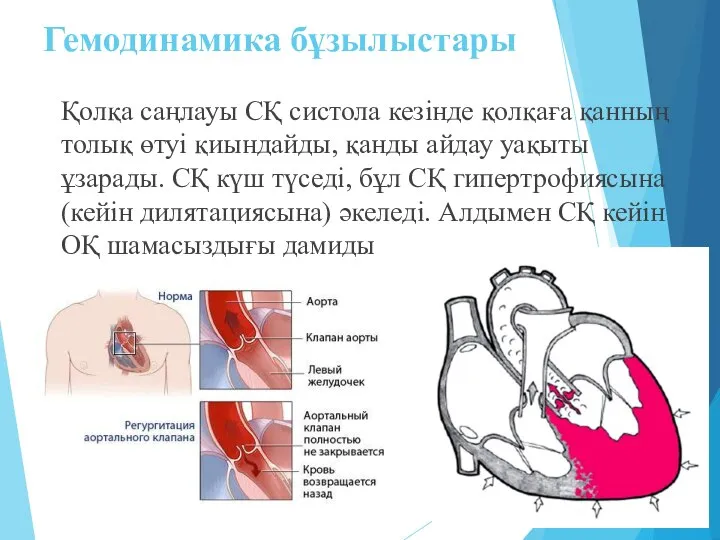 Гемодинамика бұзылыстары Қолқа саңлауы СҚ систола кезінде қолқаға қанның толық өтуі