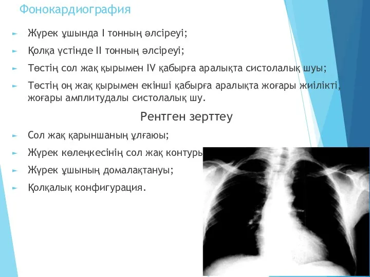 Фонокардиография Жүрек ұшында І тонның әлсіреуі; Қолқа үстінде ІІ тонның әлсіреуі;