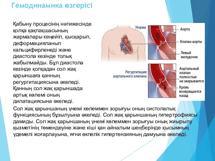 Гемодинамика өзгерісі Қабыну процесінің нәтижесінде қолқа қақпақшасының жармалары кеңейіп, қысқарып, деформацияланып