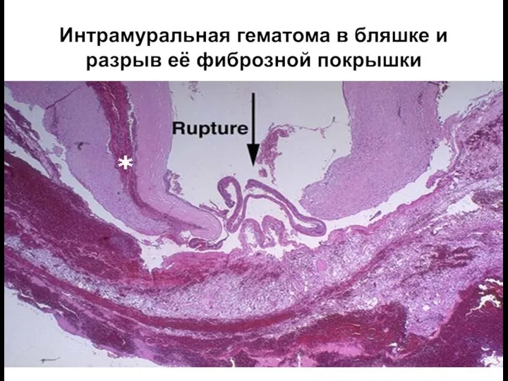 Интрамуральная гематома в бляшке и разрыв её фиброзной покрышки