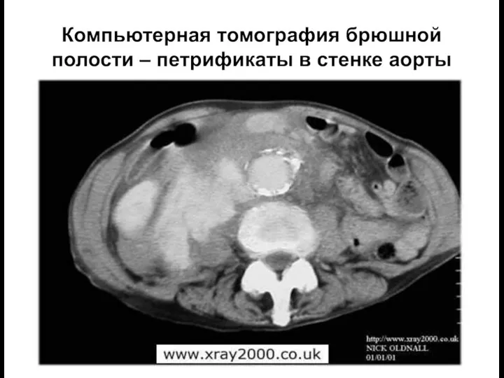 Компьютерная томография брюшной полости – петрификаты в стенке аорты