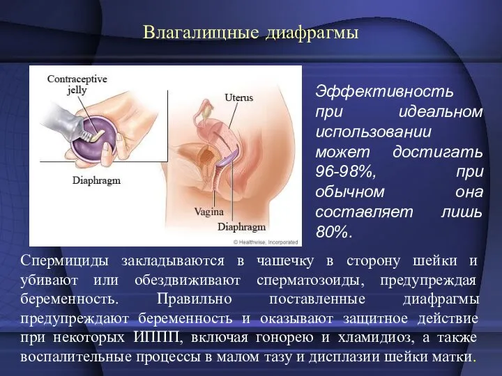 Влагалищные диафрагмы Спермициды закладываются в чашечку в сторону шейки и убивают