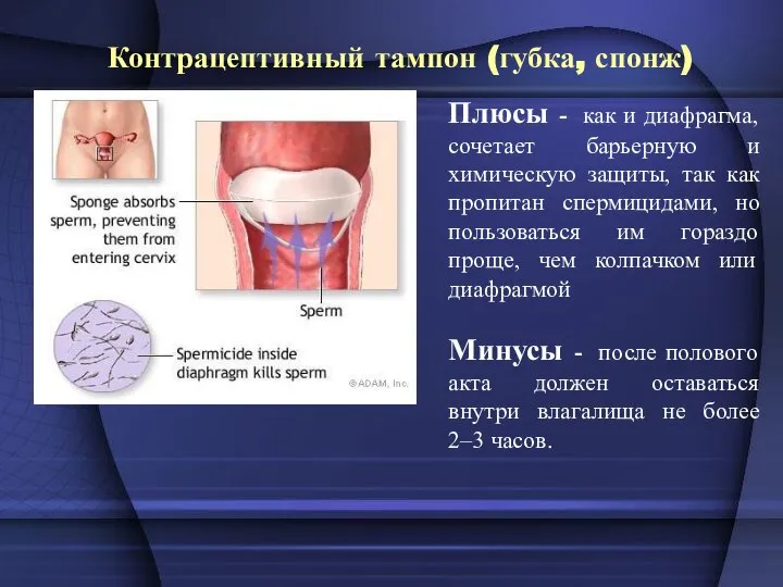 Контрацептивный тампон (губка, спонж) Плюсы - как и диафрагма, сочетает барьерную