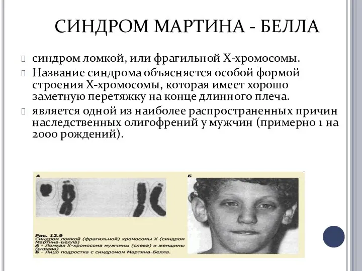 СИНДРОМ МАРТИНА - БЕЛЛА синдром ломкой, или фрагильной Х-хромосомы. Название синдрома
