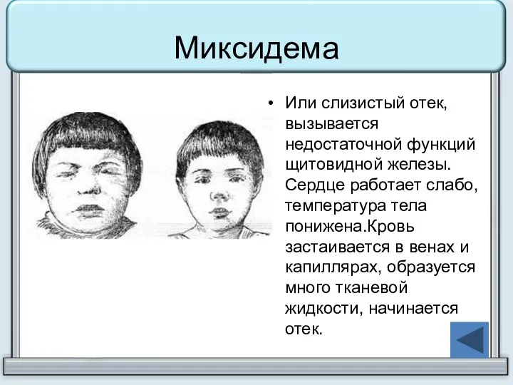 Миксидема Или слизистый отек, вызывается недостаточной функций щитовидной железы. Сердце работает