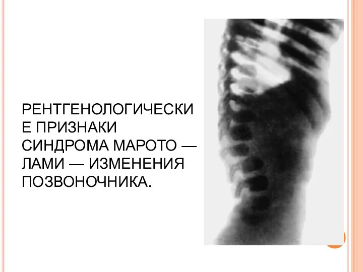 РЕНТГЕНОЛОГИЧЕСКИЕ ПРИЗНАКИ СИНДРОМА МАРОТО — ЛАМИ — ИЗМЕНЕНИЯ ПОЗВОНОЧНИКА.