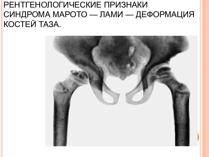 РЕНТГЕНОЛОГИЧЕСКИЕ ПРИЗНАКИ СИНДРОМА МАРОТО — ЛАМИ — ДЕФОРМАЦИЯ КОСТЕЙ ТАЗА.